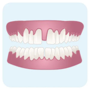 Dents écartées