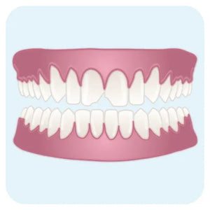Dents ébréchées