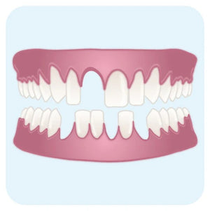 Dents manquantes