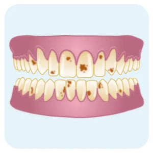Dents tachées